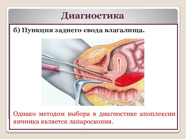 Диагностика б) Пункция заднего свода влагалища. Однако методом выбора в диагностике апоплексии яичника является лапароско­пия.
