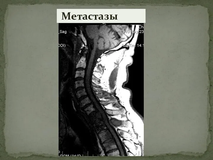 Метастазы