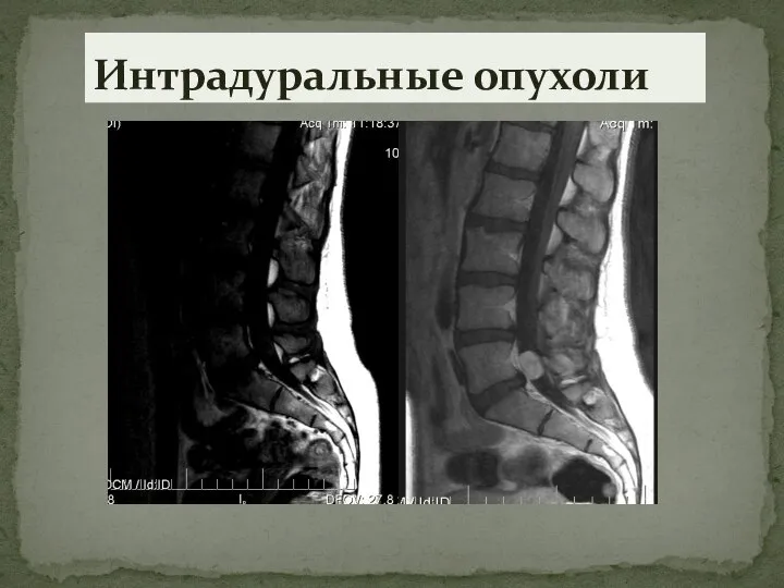 Интрадуральные опухоли