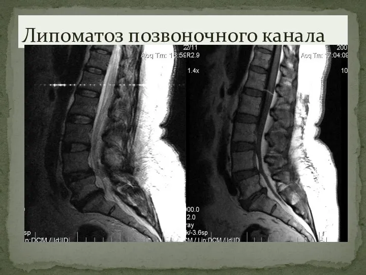 Липоматоз позвоночного канала