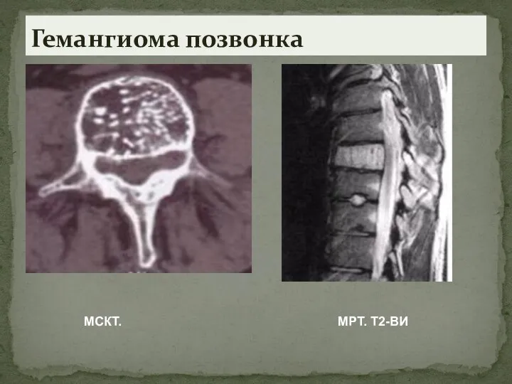 Гемангиома позвонка МСКТ. МРТ. Т2-ВИ