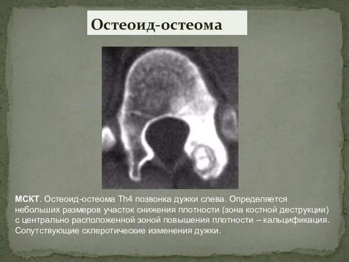 Остеоид-остеома МСКТ. Остеоид-остеома Th4 позвонка дужки слева. Определяется небольших размеров участок снижения