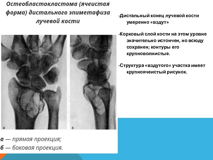 -Дистальный конец лучевой кости умеренно «вздут» -Корковый слой кости на этом уровне