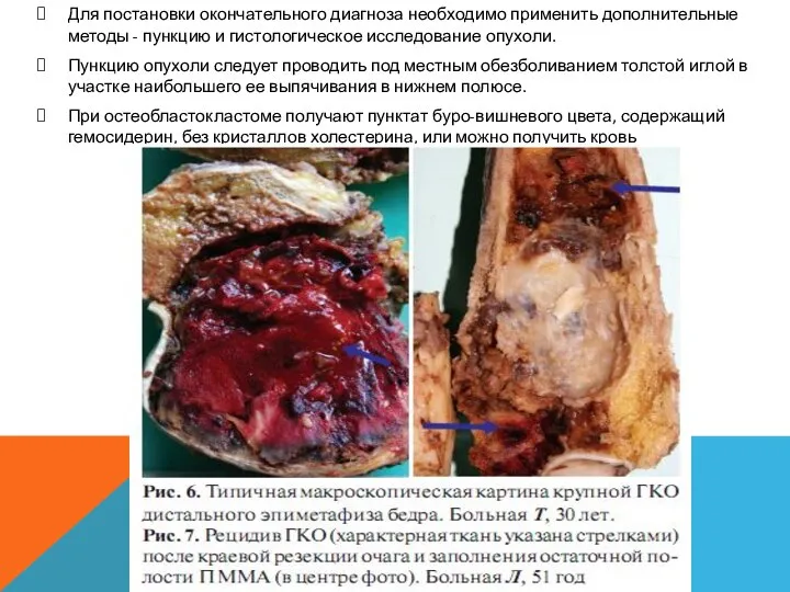 Для постановки окончательного диагноза необходимо применить дополнительные методы - пункцию и гистологическое