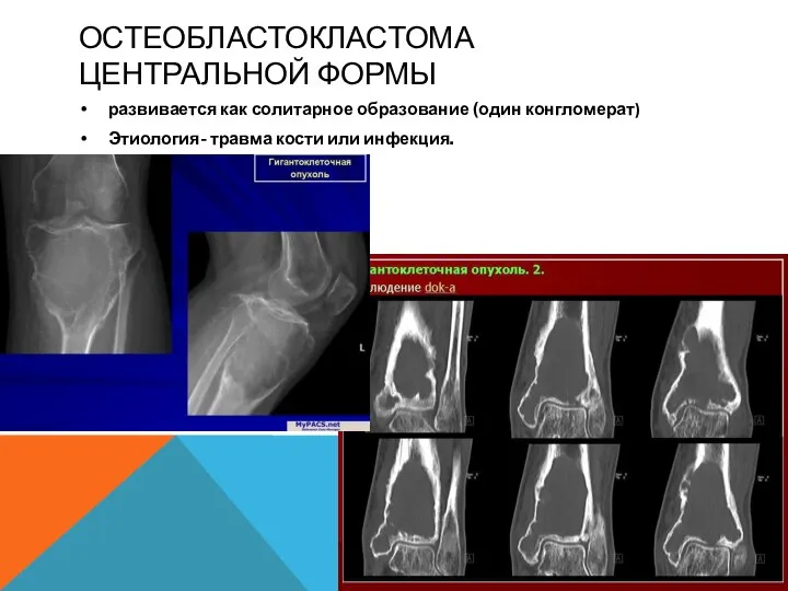 ОСТЕОБЛАСТОКЛАСТОМА ЦЕНТРАЛЬНОЙ ФОРМЫ развивается как солитарное образование (один конгломерат) Этиология- травма кости или инфекция.