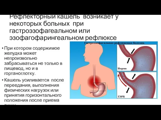 Рефлекторный кашель возникает у некоторых больных при гастроэзофагеальном или эзофагофарингеальном рефлюксе При