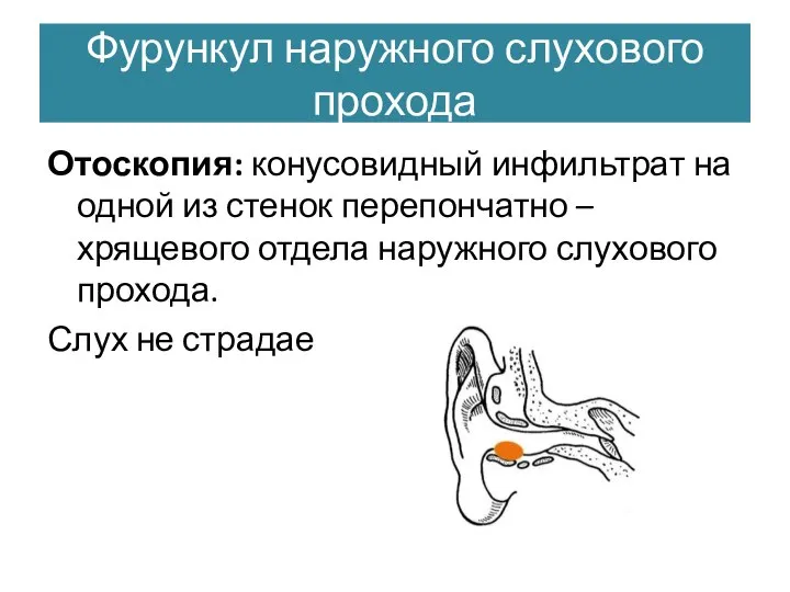 Фурункул наружного слухового прохода Отоскопия: конусовидный инфильтрат на одной из стенок перепончатно