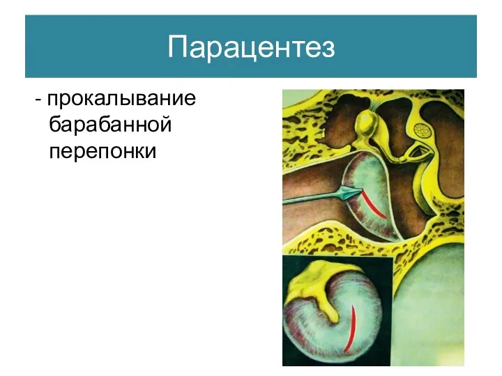 Парацентез - прокалывание барабанной перепонки