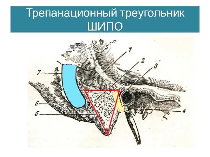 Трепанационный треугольник ШИПО