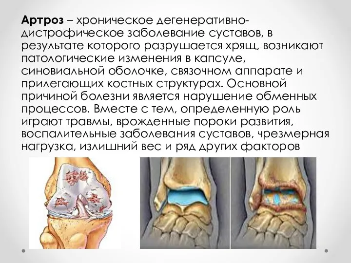 Артроз – хроническое дегенеративно-дистрофическое заболевание суставов, в результате которого разрушается хрящ, возникают