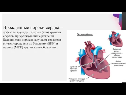 Врожденные пороки сердца – дефект в структуре сердца и (или) крупных сосудов,