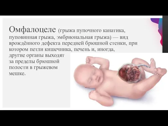 Омфалоцеле (грыжа пупочного канатика, пуповинная грыжа, эмбриональная грыжа) — вид врождённого дефекта