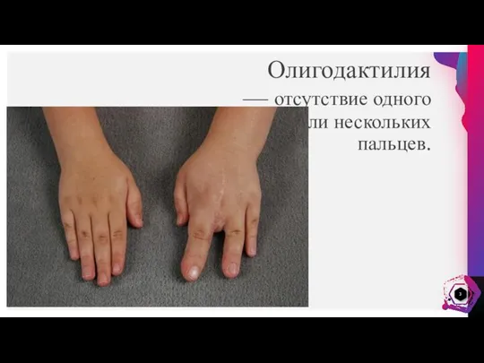 Олигодактилия — отсутствие одного или нескольких пальцев.