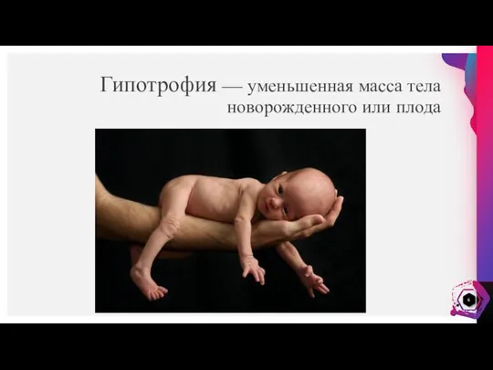 Гипотрофия — уменьшенная масса тела новорожденного или плода