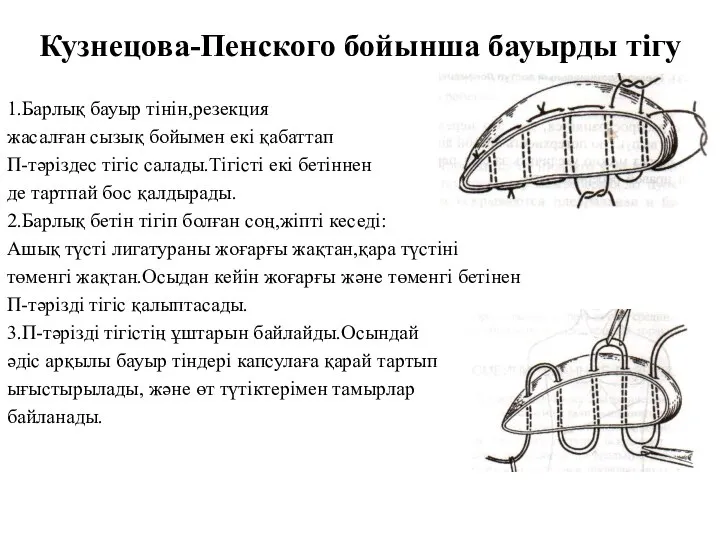 Кузнецова-Пенского бойынша бауырды тігу 1.Барлық бауыр тінін,резекция жасалған сызық бойымен екі қабаттап