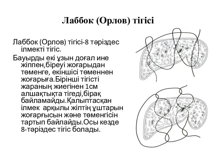 Лаббок (Орлов) тігісі Лаббок (Орлов) тігісі-8 тәріздес ілмекті тігіс. Бауырды екі ұзын