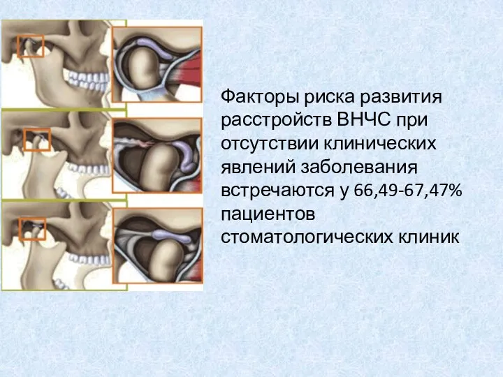 Факторы риска развития расстройств ВНЧС при отсутствии клинических явлений заболевания встречаются у 66,49-67,47% пациентов стоматологических клиник