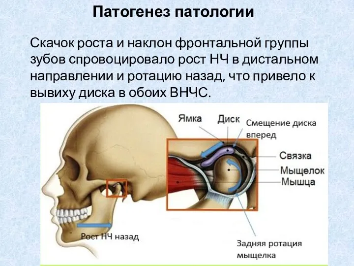 Патогенез патологии Скачок роста и наклон фронтальной группы зубов спровоцировало рост НЧ