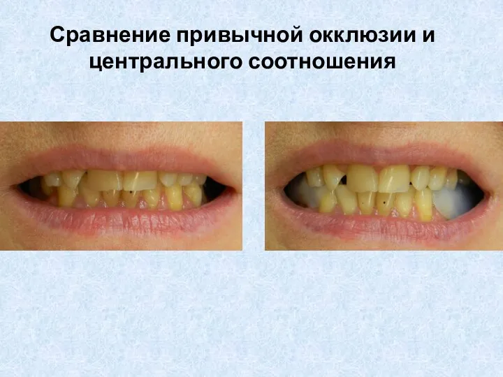 Сравнение привычной окклюзии и центрального соотношения