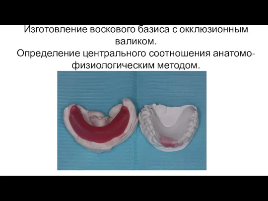 Изготовление воскового базиса с окклюзионным валиком. Определение центрального соотношения анатомо-физиологическим методом.