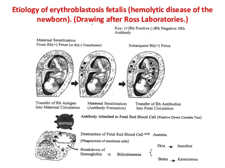 Etiology of erythroblastosis fetalis (hemolytic disease of the newborn). (Drawing after Ross Laboratories.)
