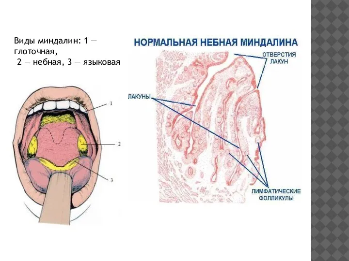 Виды миндалин: 1 — глоточная, 2 — небная, 3 — языковая