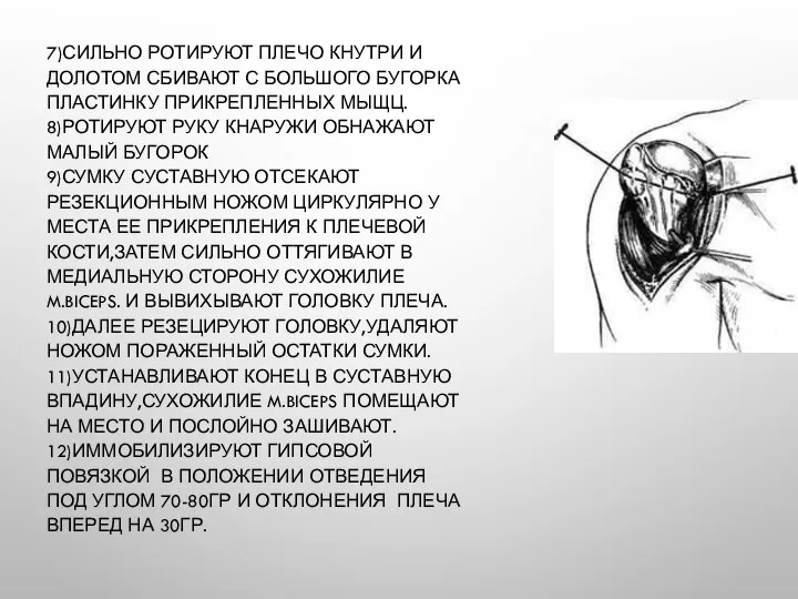 7)СИЛЬНО РОТИРУЮТ ПЛЕЧО КНУТРИ И ДОЛОТОМ СБИВАЮТ С БОЛЬШОГО БУГОРКА ПЛАСТИНКУ ПРИКРЕПЛЕННЫХ