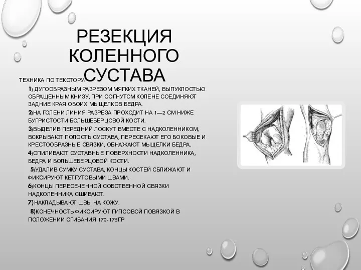 РЕЗЕКЦИЯ КОЛЕННОГО СУСТАВА ТЕХНИКА ПО ТЕКСТОРУ: 1) ДУГООБРАЗНЫМ РАЗРЕЗОМ МЯГКИХ ТКАНЕЙ, ВЫПУКЛОСТЬЮ