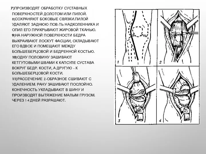 7)ПРОИЗВОДЯТ ОБРАБОТКУ СУСТАВНЫХ ПОВЕРХНОСТЕЙ ДОЛОТОМ ИЛИ ПИЛОЙ. 8)СОХРАНЯЮТ БОКОВЫЕ СВЯЗКИ.ПИЛОЙ УДАЛЯЮТ ЗАДНЮЮ