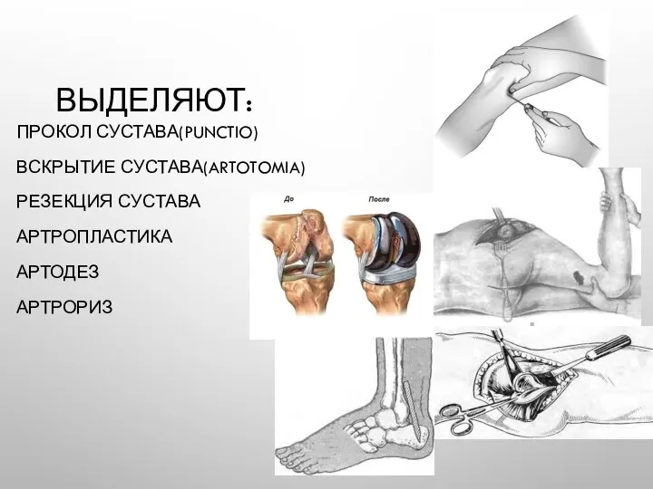 ВЫДЕЛЯЮТ: ПРОКОЛ СУСТАВА(PUNCTIO) ВСКРЫТИЕ СУСТАВА(ARTOTOMIA) РЕЗЕКЦИЯ СУСТАВА АРТРОПЛАСТИКА АРТОДЕЗ АРТРОРИЗ