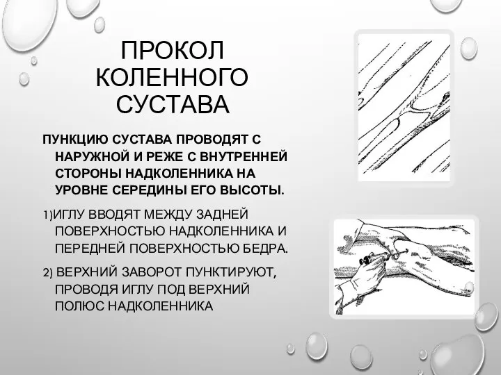 ПРОКОЛ КОЛЕННОГО СУСТАВА ПУНКЦИЮ СУСТАВА ПРОВОДЯТ С НАРУЖНОЙ И РЕЖЕ С ВНУТРЕННЕЙ