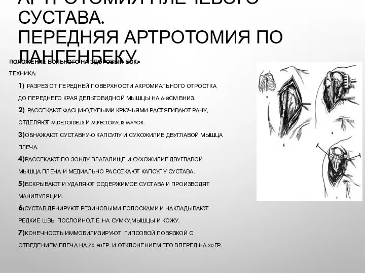 АРТРОТОМИЯ ПЛЕЧЕВОГО СУСТАВА. ПЕРЕДНЯЯ АРТРОТОМИЯ ПО ЛАНГЕНБЕКУ. ПОЛОЖЕНИЕ БОЛЬНОГО НА ЗДОРОВЫЙ БОК.