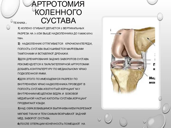 АРТРОТОМИЯ КОЛЕННОГО СУСТАВА ТЕХНИКА : 1) КОЛЕНО СГИБАЮТ.ДЕЛАЕТСЯ 2 ВЕРТИКАЛЬНЫХ РАЗРЕЗА НА