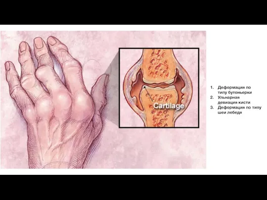 Деформация по типу бутоньерки Ульнарная девиация кисти Деформация по типу шеи лебедя
