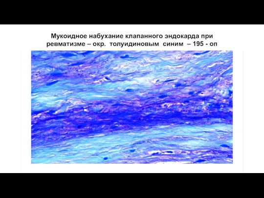 Мукоидное набухание клапанного эндокарда при ревматизме – окр. толуидиновым синим – 195 - оп