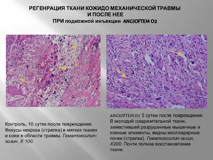 РЕГЕНРАЦИЯ ТКАНИ КОЖИДО МЕХАНИЧЕСКОЙ ТРАВМЫ И ПОСЛЕ НЕЕ ПРИ подкожной инъекции ANGIOFTEM