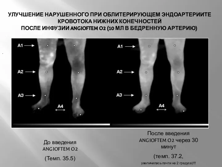 УЛУЧШЕНИЕ НАРУШЕННОГО ПРИ ОБЛИТЕРИРУЮЩЕМ ЭНДОАРТЕРИИТЕ КРОВОТОКА НИЖНИХ КОНЕЧНОСТЕЙ ПОСЛЕ ИНФУЗИИ ANGIOFTEM O2