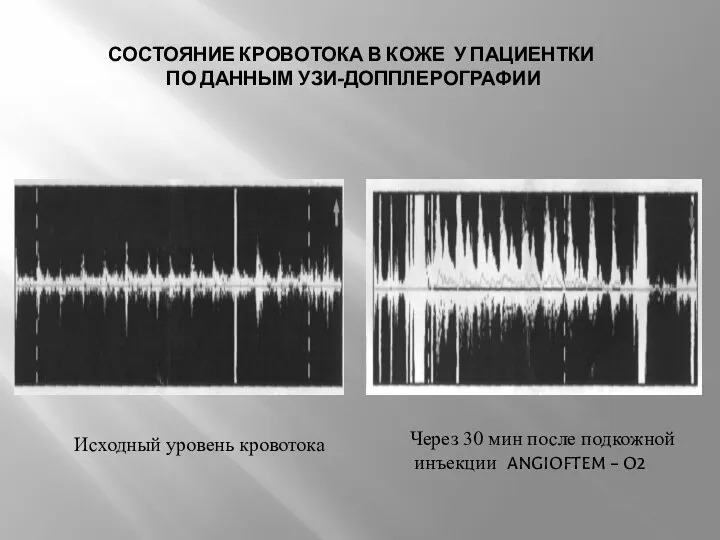 СОСТОЯНИЕ КРОВОТОКА В КОЖЕ У ПАЦИЕНТКИ ПО ДАННЫМ УЗИ-ДОППЛЕРОГРАФИИ Исходный уровень кровотока