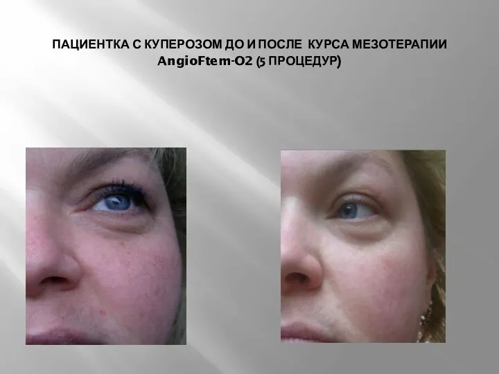 ПАЦИЕНТКА С КУПЕРОЗОМ ДО И ПОСЛЕ КУРСА МЕЗОТЕРАПИИ AngioFtem-O2 (5 ПРОЦЕДУР)