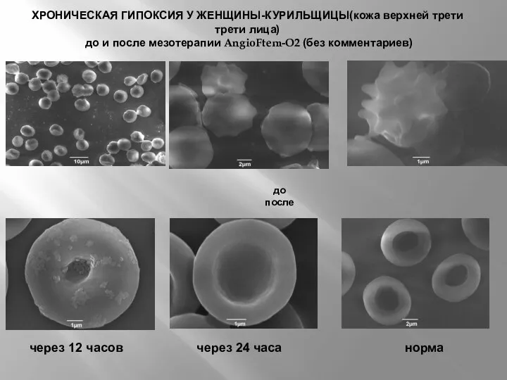 ХРОНИЧЕСКАЯ ГИПОКСИЯ У ЖЕНЩИНЫ-КУРИЛЬЩИЦЫ(кожа верхней трети трети лица) до и после мезотерапии