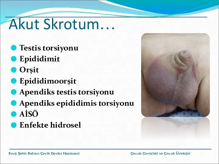 Akut Skrotum… Testis torsiyonu Epididimit Orşit Epididimoorşit Apendiks testis torsiyonu Apendiks epididimis