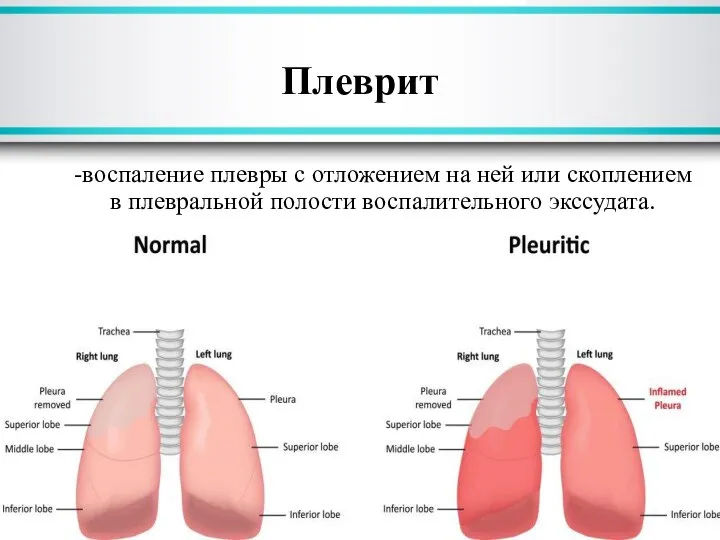 Плеврит -воспаление плевры с отложением на ней или скоплением в плевральной полости воспалительного экссудата.