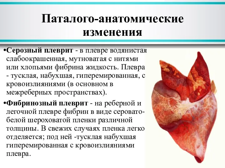 Серозный плеврит - в плевре водянистая слабоокрашенная, мутноватая с нитями или хлопьями