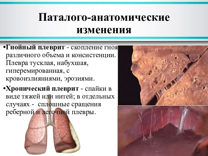 Гнойный плеврит - скопление гноя различного объема и консистенции. Плевра тусклая, набухшая,