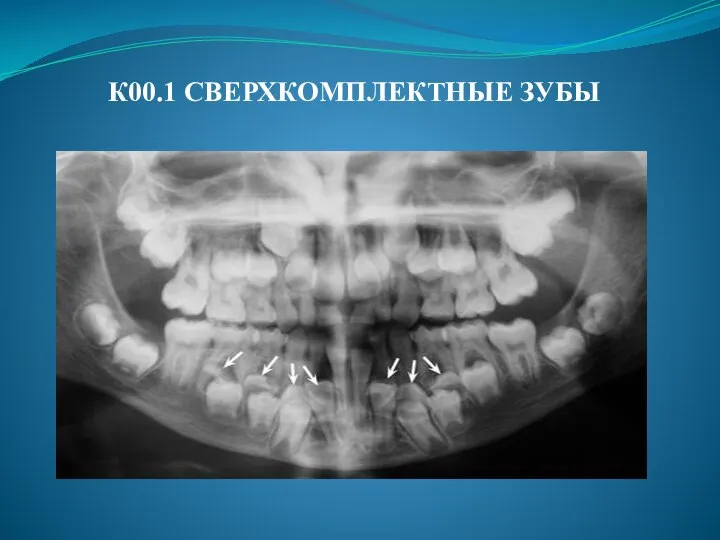 К00.1 СВЕРХКОМПЛЕКТНЫЕ ЗУБЫ