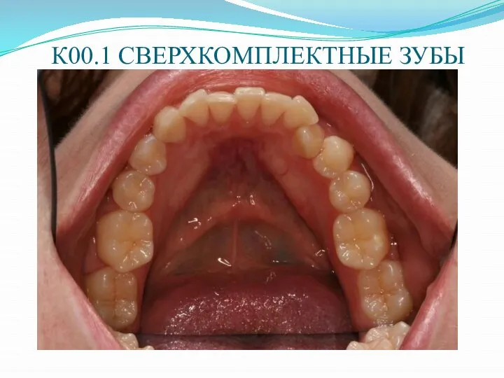 К00.1 СВЕРХКОМПЛЕКТНЫЕ ЗУБЫ