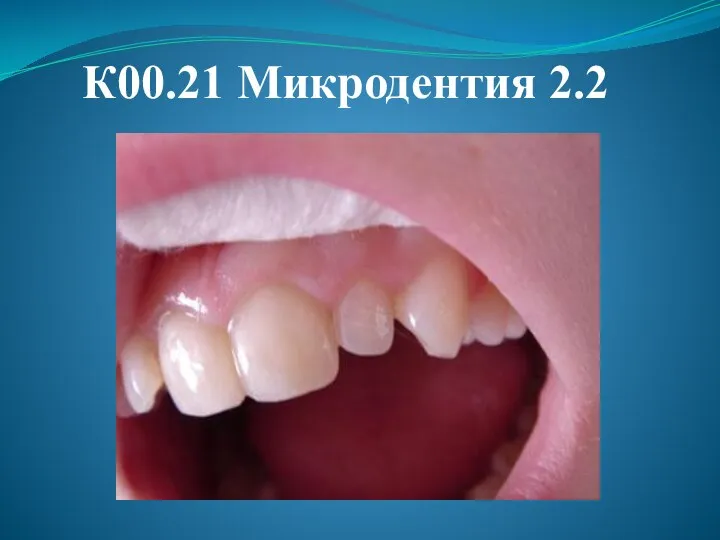 К00.21 Микродентия 2.2