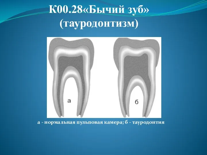 К00.28«Бычий зуб» (тауродонтизм) а - нормальная пульповая камера; б - тауродонтия