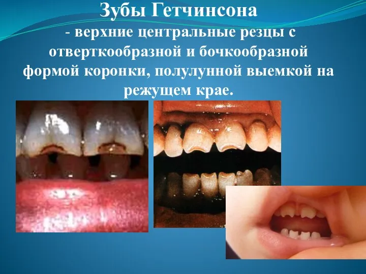 Зубы Гетчинсона - верхние центральные резцы с отверткообразной и бочкообразной формой коронки,