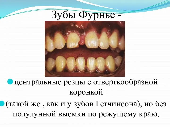 Зубы Фурнье - центральные резцы с отверткообразной коронкой (такой же , как